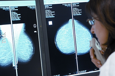 Brustkrebs bei Frauen