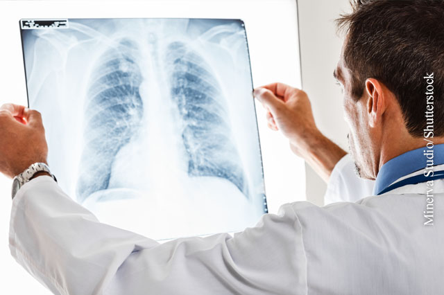 Ist Lungenfibrose autoimmun-bedingt?